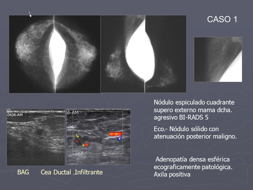 CASO 1 Nódulo espiculado cuadrante supero externo mama dcha. agresivo BI-RADS 5. Eco.- Nódulo sólido con atenuación posterior maligno.