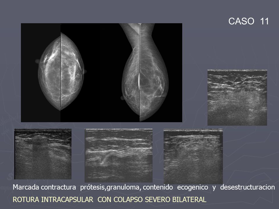 CASO 11 Marcada contractura prótesis,granuloma, contenido ecogenico y desestructuracion.