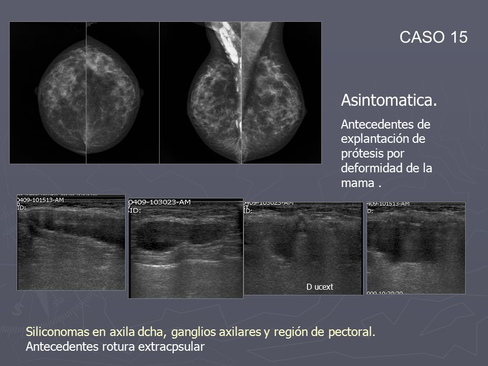 CASO 15 Asintomatica. Antecedentes de explantación de prótesis por deformidad de la mama . D ucext.