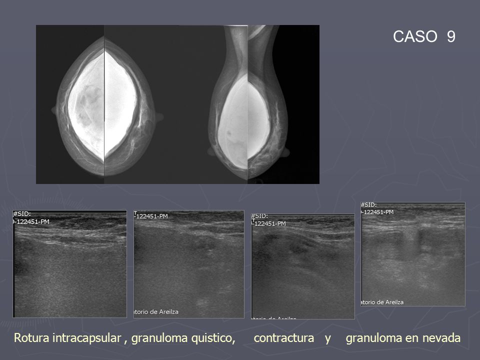 CASO 9 Rotura intracapsular , granuloma quistico, contractura y granuloma en nevada