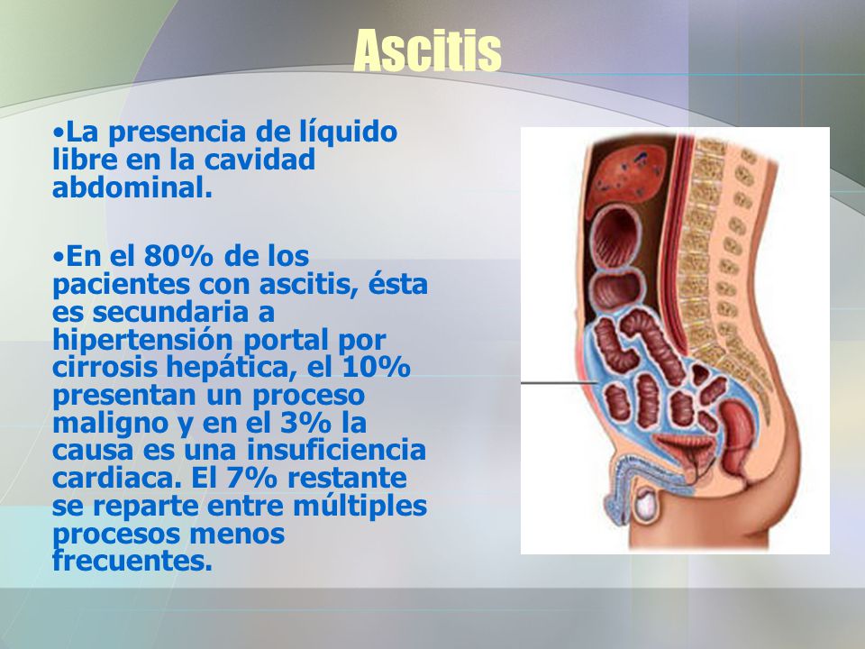 Ascitis La presencia de líquido libre en la cavidad abdominal.