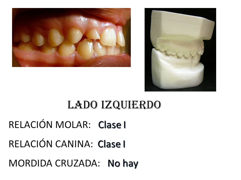 LADO IZQUIERDO RELACIÓN MOLAR: Clase I RELACIÓN CANINA: Clase I