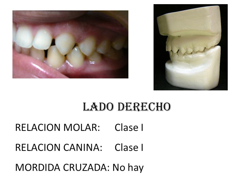 LADO DERECHO RELACION MOLAR: Clase I RELACION CANINA: Clase I
