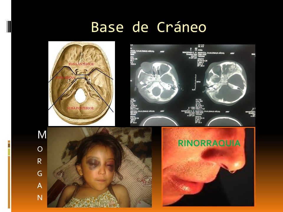 Base de Cráneo M O R G A N RINORRAQUIA
