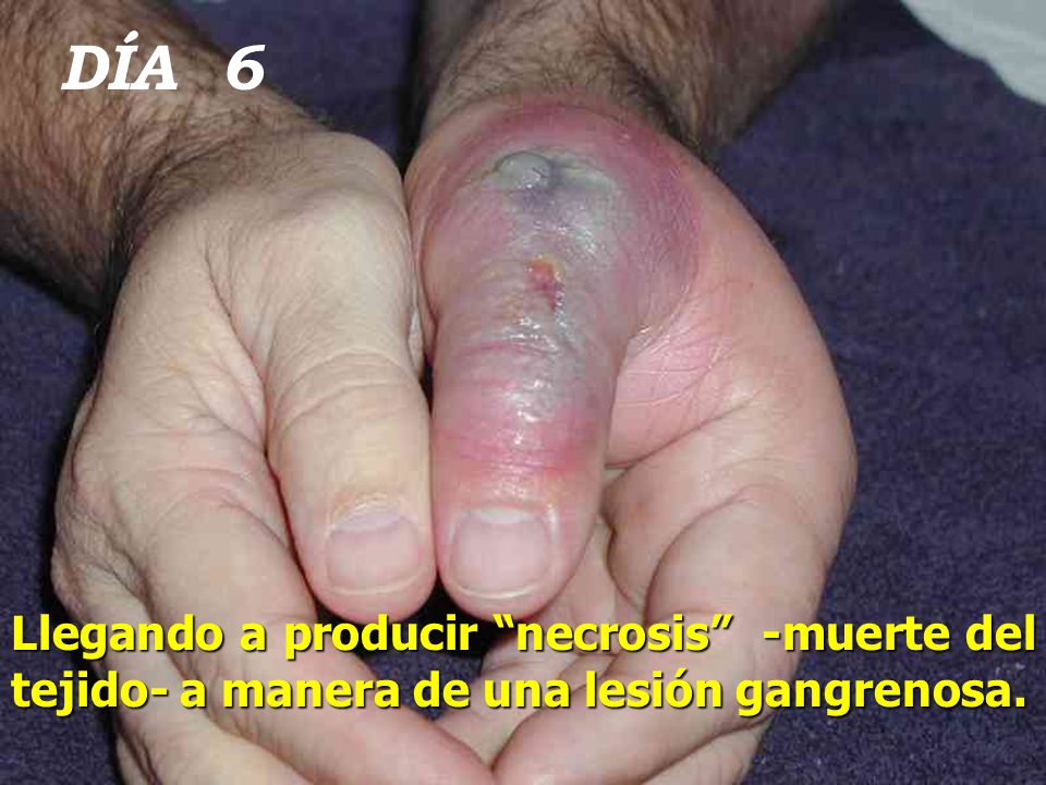 DÍA 6 Llegando a producir necrosis -muerte del tejido- a manera de una lesión gangrenosa.
