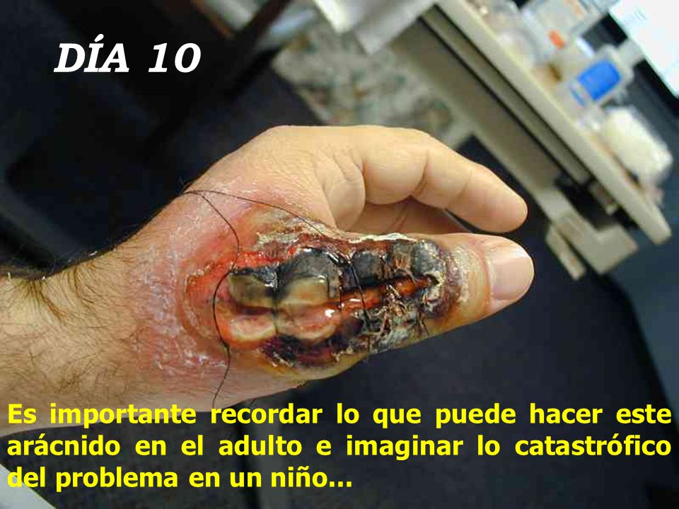 DÍA 10 Es importante recordar lo que puede hacer este arácnido en el adulto e imaginar lo catastrófico del problema en un niño...