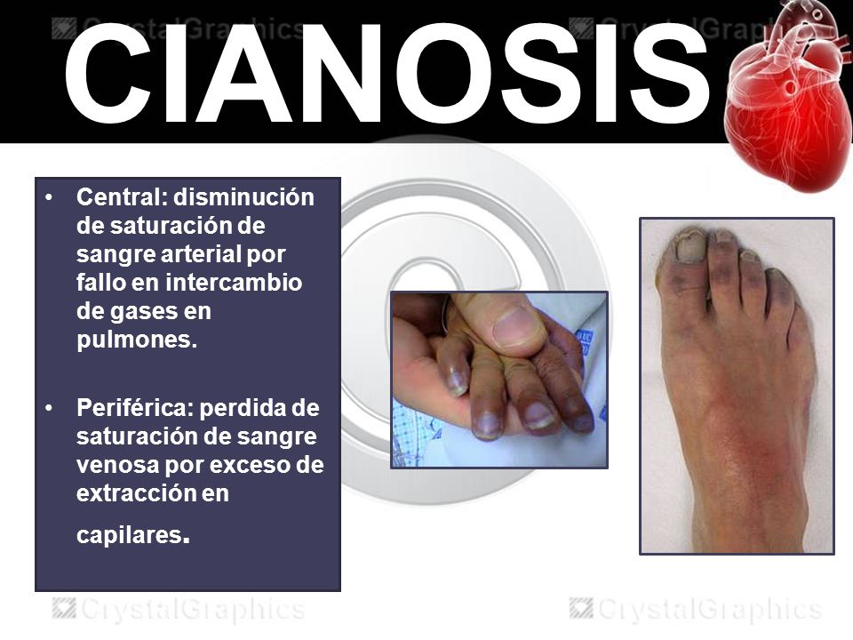 CIANOSIS Central: disminución de saturación de sangre arterial por fallo en intercambio de gases en pulmones.