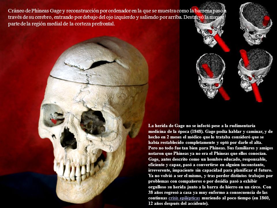 Cráneo de Phineas Gage y reconstrucción por ordenador en la que se muestra como la barrena pasó a través de su cerebro, entrando por debajo del ojo izquierdo y saliendo por arriba. Destruyó la mayor parte de la región medial de la corteza prefrontal.