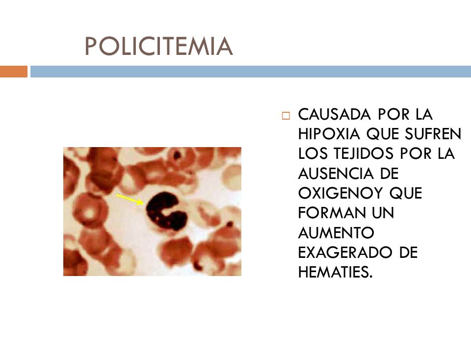 POLICITEMIA CAUSADA POR LA HIPOXIA QUE SUFREN LOS TEJIDOS POR LA AUSENCIA DE OXIGENOY QUE FORMAN UN AUMENTO EXAGERADO DE HEMATIES.