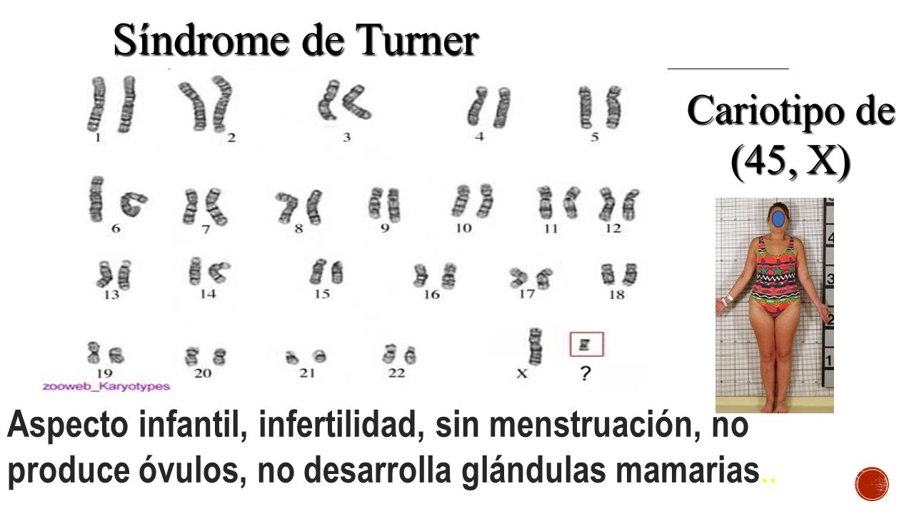Síndrome de Turner Cariotipo de (45, X)