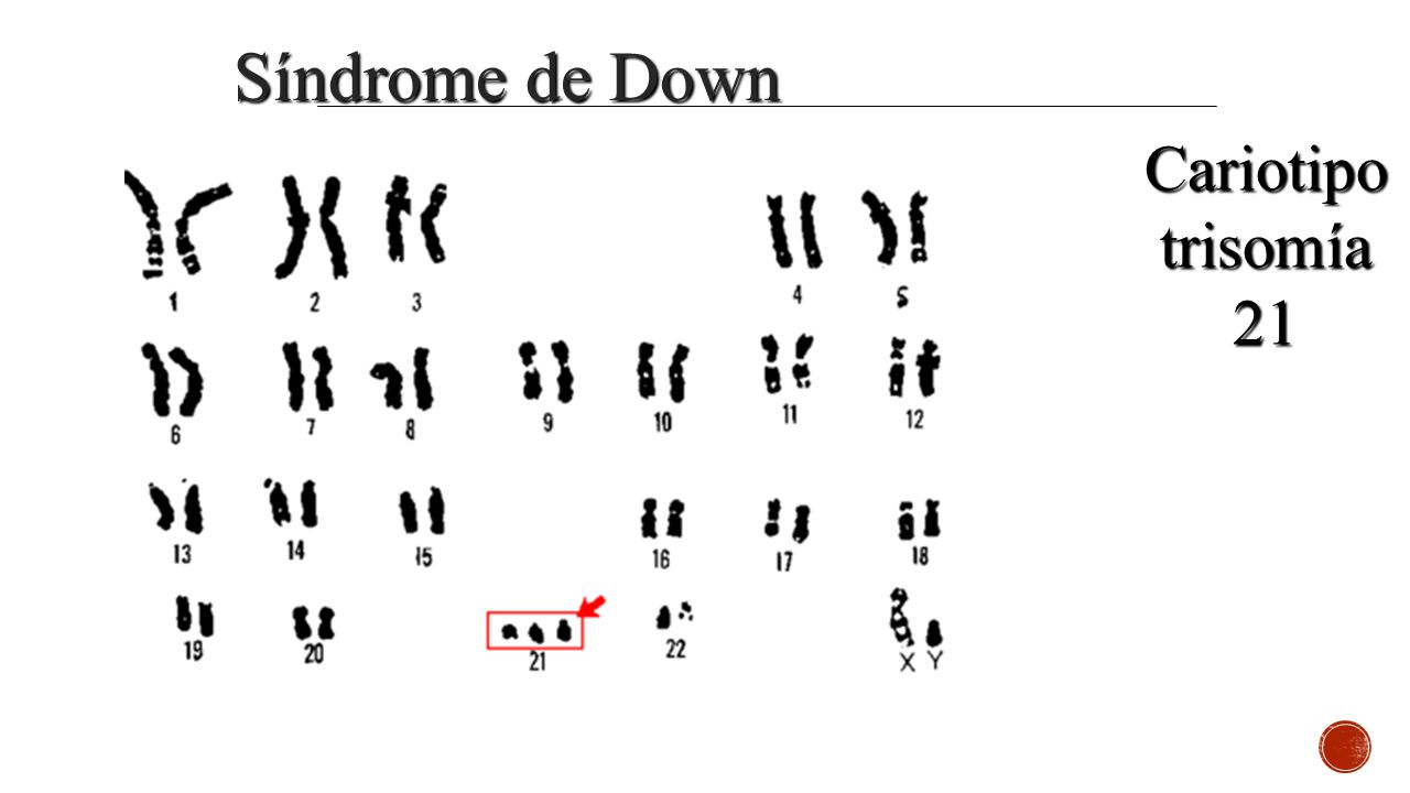 Síndrome de Down Cariotipo trisomía 21