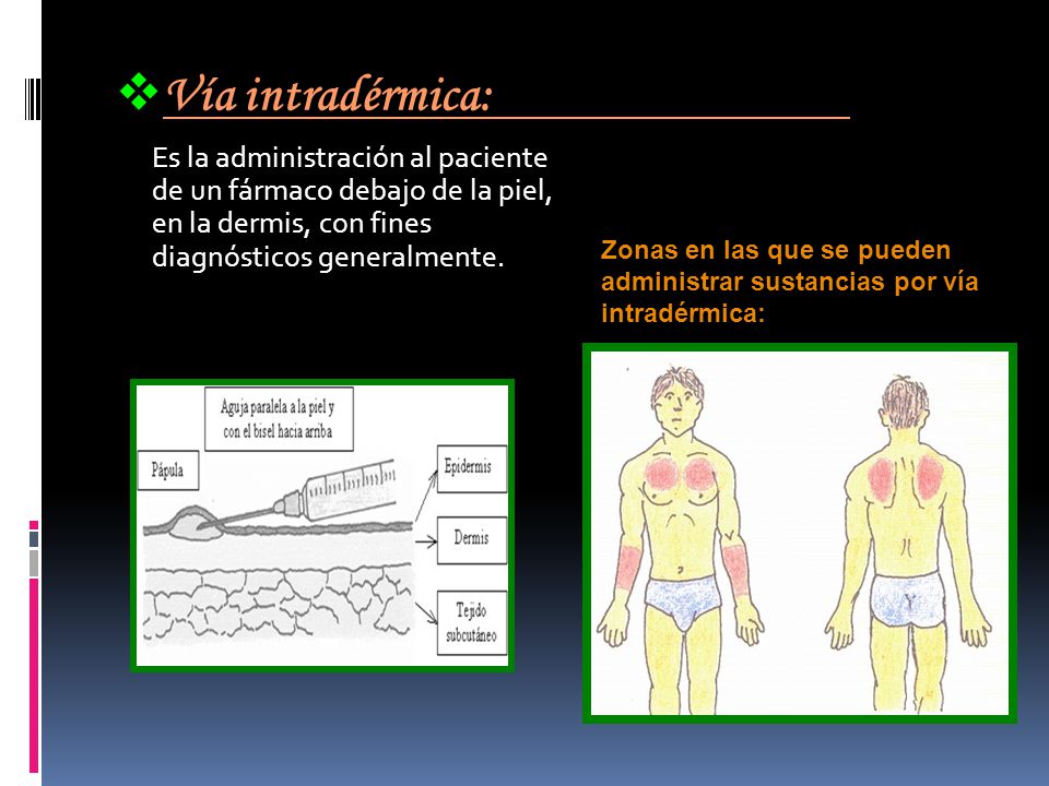Vía intradérmica: Es la administración al paciente de un fármaco debajo de la piel, en la dermis, con fines diagnósticos generalmente.