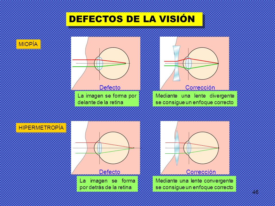 DEFECTOS DE LA VISIÓN Defecto Corrección Defecto Corrección MIOPÍA