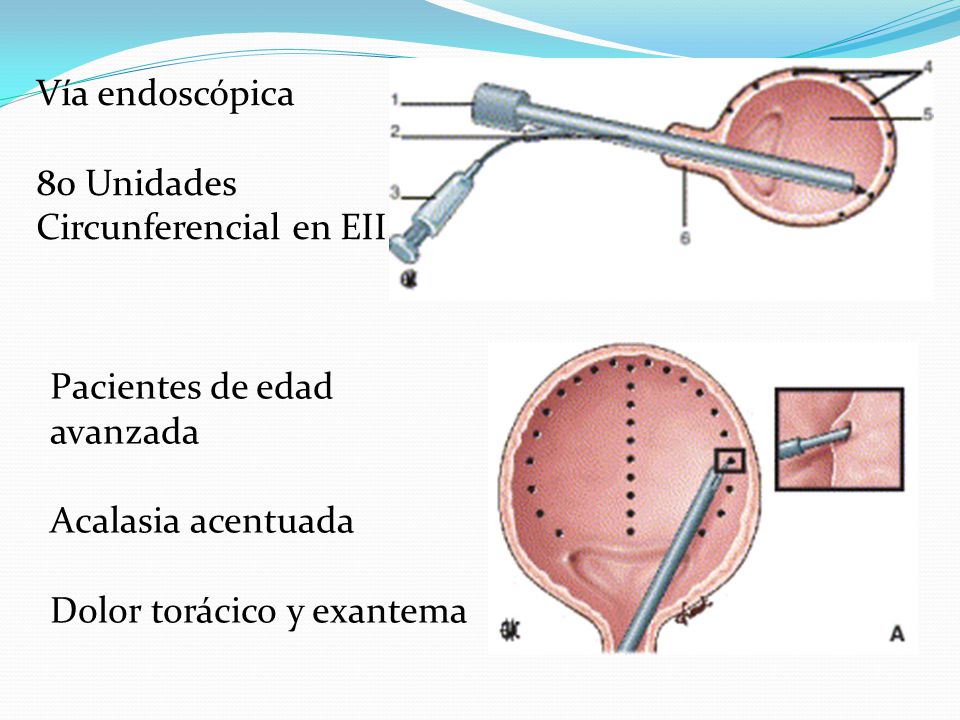 Vía endoscópica 80 Unidades. Circunferencial en EII. Pacientes de edad avanzada. Acalasia acentuada.