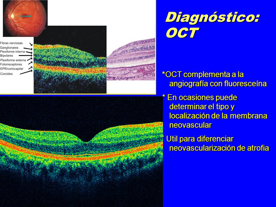 Diagnóstico: OCT *OCT complementa a la angiografía con fluoresceína