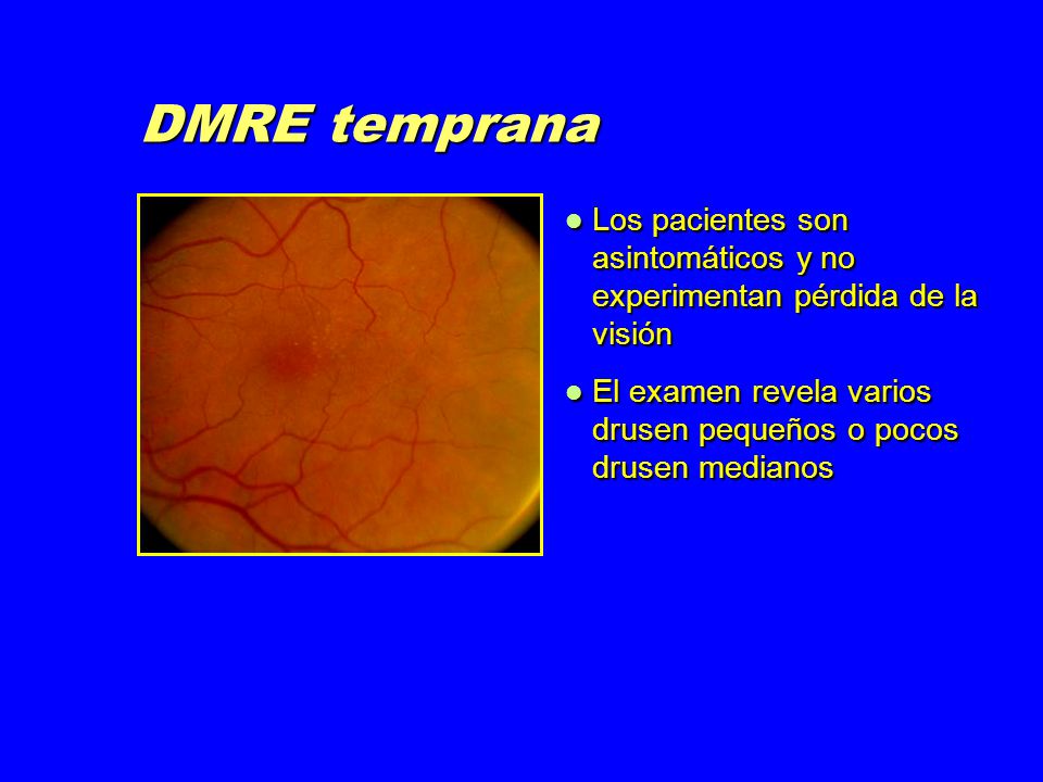 DMRE temprana Los pacientes son asintomáticos y no experimentan pérdida de la visión.