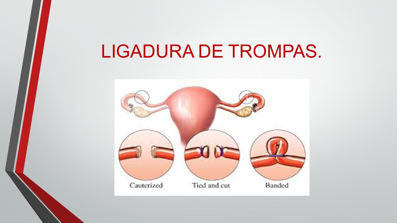 LIGADURA DE TROMPAS.