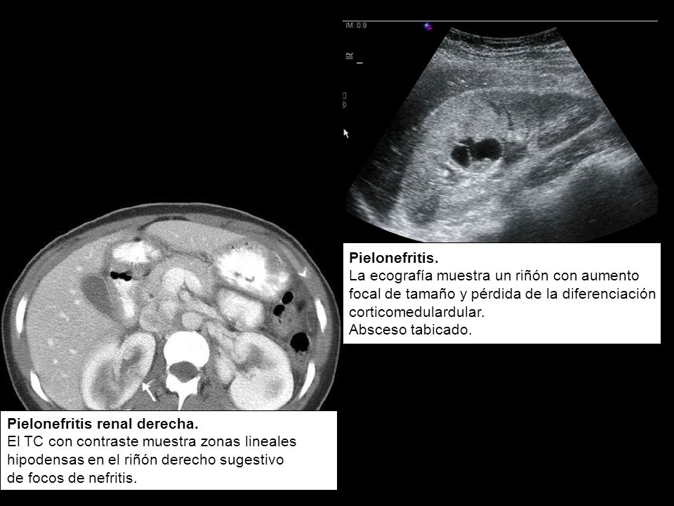 Pielonefritis. La ecografía muestra un riñón con aumento. focal de tamaño y pérdida de la diferenciación.