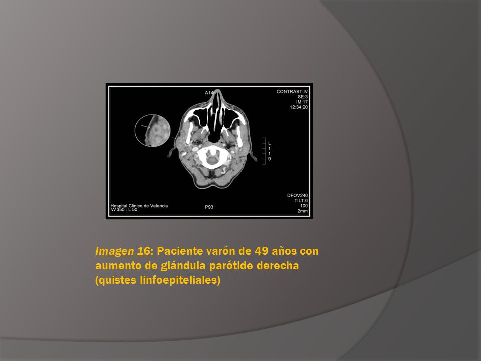 Imagen 16: Paciente varón de 49 años con aumento de glándula parótide derecha (quistes linfoepiteliales)