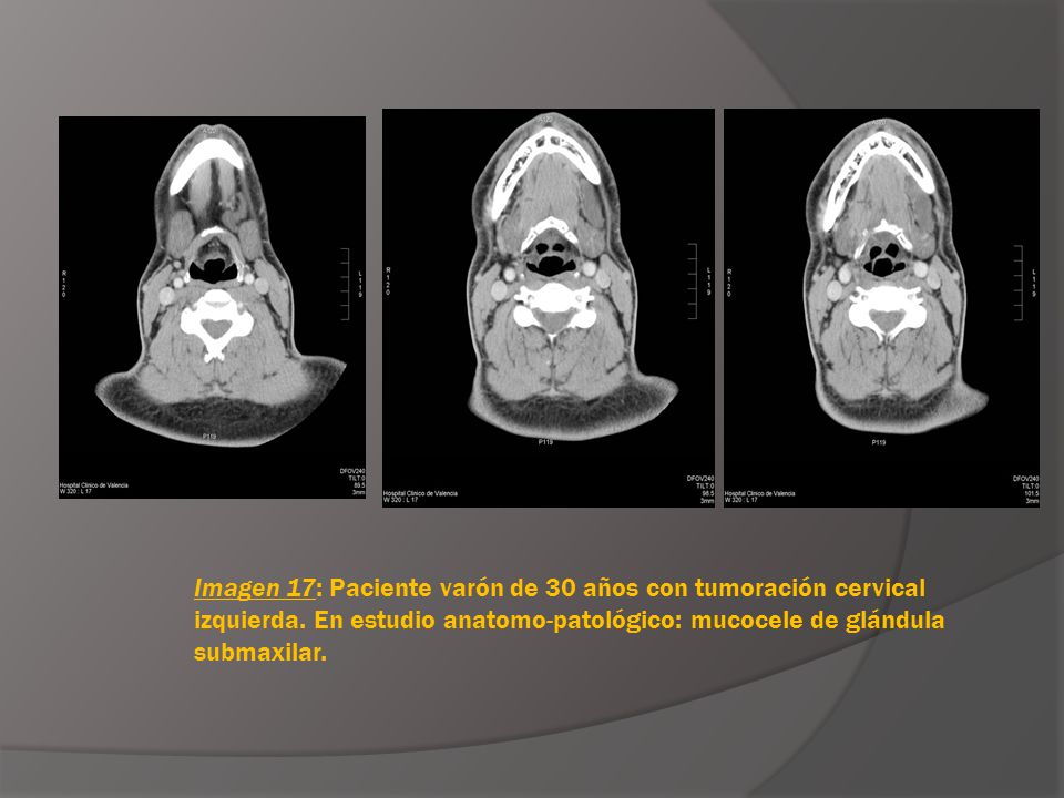 Imagen 17: Paciente varón de 30 años con tumoración cervical izquierda