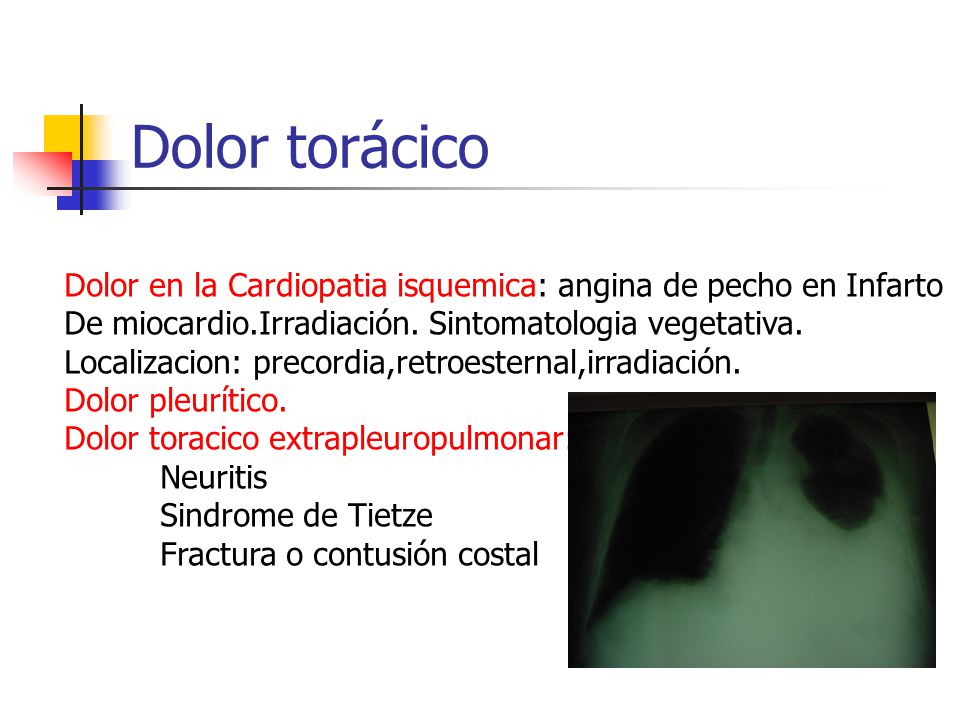 Dolor torácico Dolor en la Cardiopatia isquemica: angina de pecho en Infarto. De miocardio.Irradiación. Sintomatologia vegetativa.