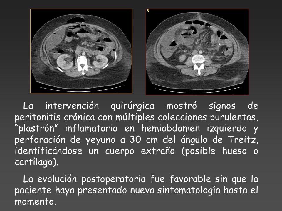 La intervención quirúrgica mostró signos de peritonitis crónica con múltiples colecciones purulentas, plastrón inflamatorio en hemiabdomen izquierdo y perforación de yeyuno a 30 cm del ángulo de Treitz, identificándose un cuerpo extraño (posible hueso o cartílago).