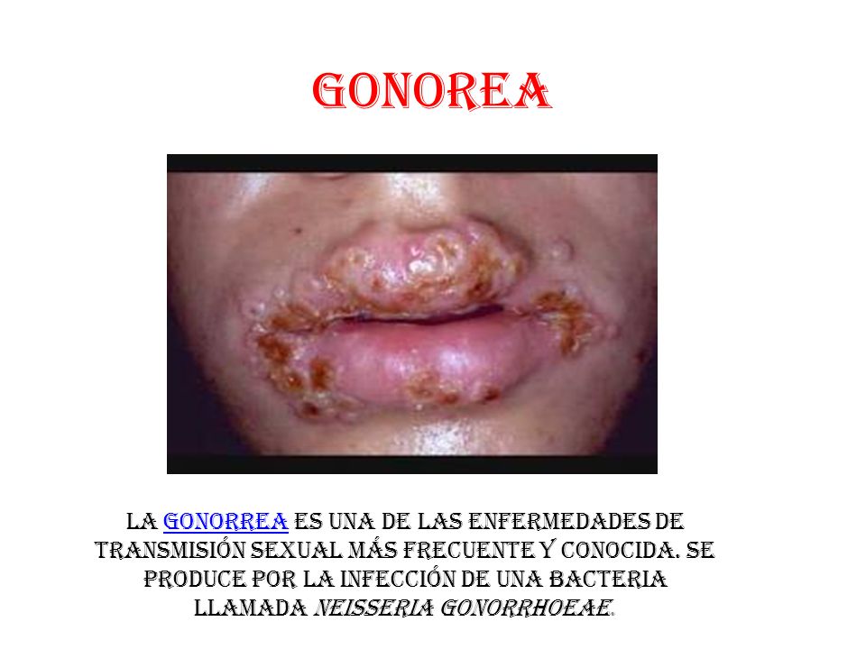 Q causa la gonorrea