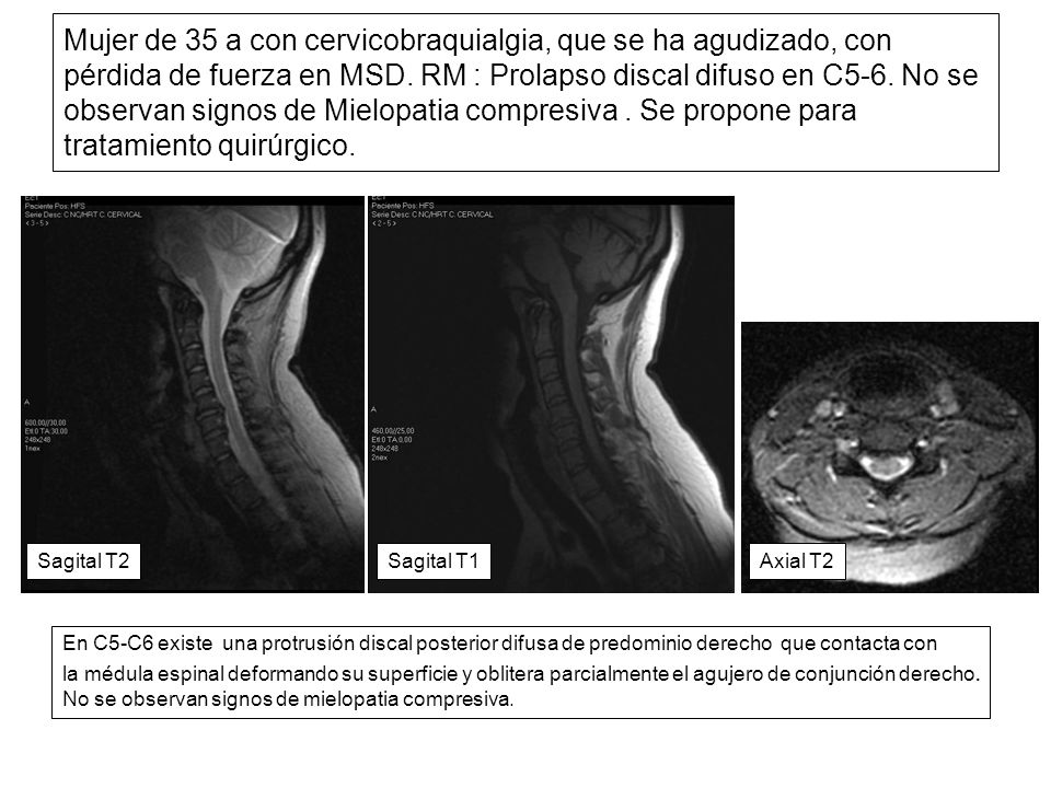Mujer de 35 a con cervicobraquialgia, que se ha agudizado, con pérdida de fuerza en MSD. RM : Prolapso discal difuso en C5-6. No se observan signos de Mielopatia compresiva . Se propone para tratamiento quirúrgico.