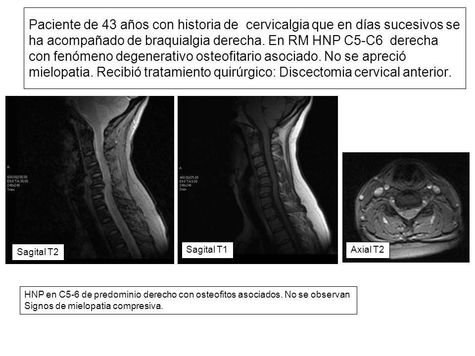 Paciente de 43 años con historia de cervicalgia que en días sucesivos se ha acompañado de braquialgia derecha. En RM HNP C5-C6 derecha con fenómeno degenerativo osteofitario asociado. No se apreció mielopatia. Recibió tratamiento quirúrgico: Discectomia cervical anterior.