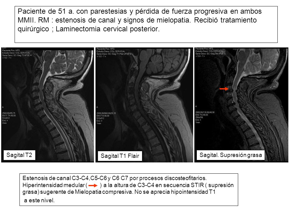 Paciente de 51 a. con parestesias y pérdida de fuerza progresiva en ambos MMII. RM : estenosis de canal y signos de mielopatia. Recibió tratamiento quirúrgico ; Laminectomia cervical posterior.