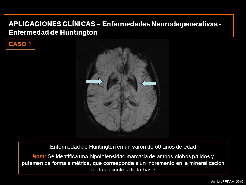 Enfermedad de Huntington en un varón de 59 años de edad