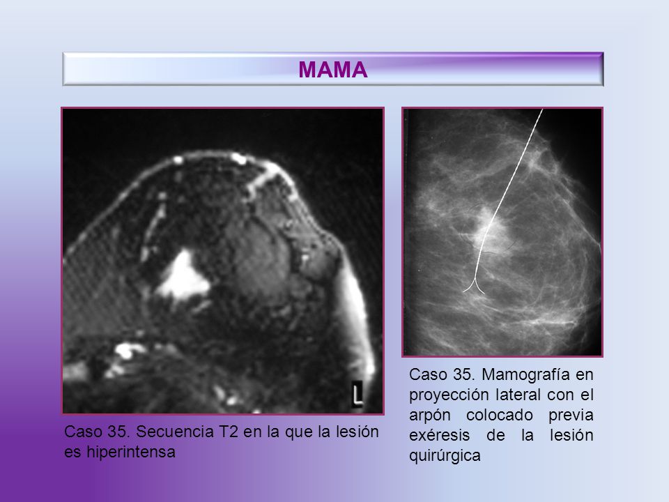 MAMA Caso 35. Mamografía en proyección lateral con el arpón colocado previa exéresis de la lesión quirúrgica.