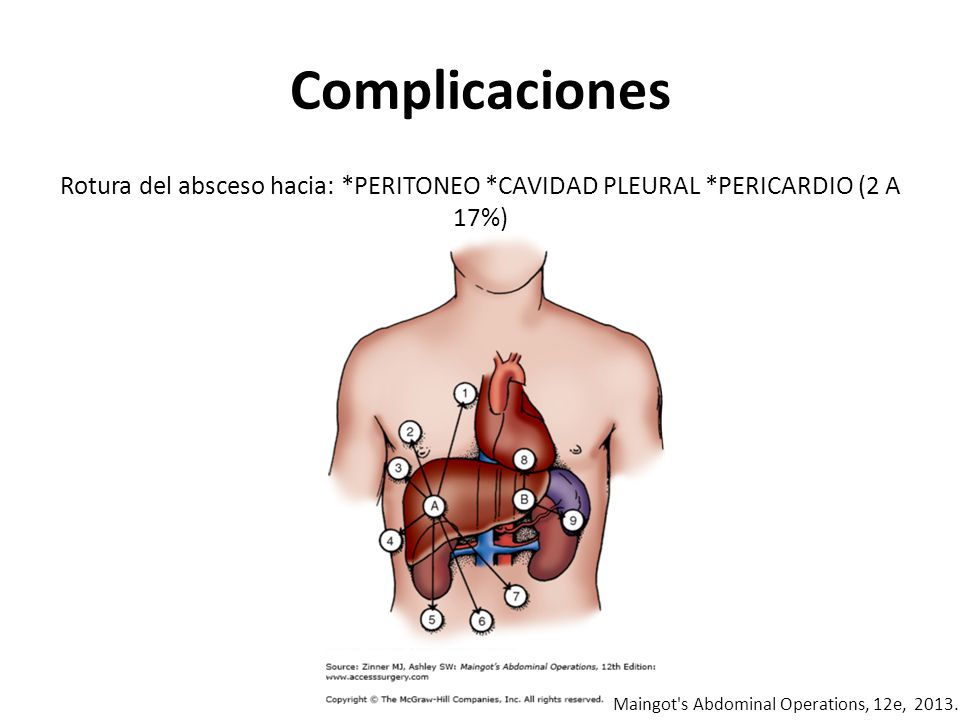 Complicaciones Rotura del absceso hacia: *PERITONEO *CAVIDAD PLEURAL *PERICARDIO (2 A 17%) Maingot s Abdominal Operations, 12e,