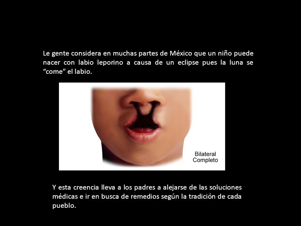 Le gente considera en muchas partes de México que un niño puede nacer con labio leporino a causa de un eclipse pues la luna se come el labio.