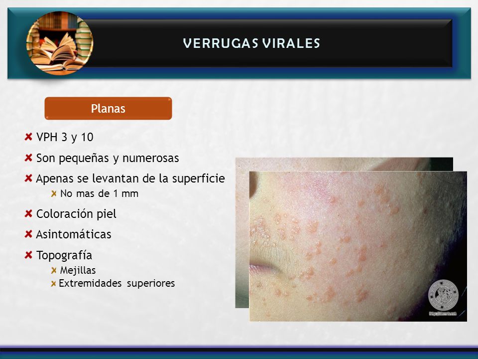 Verrugas VIRALES Planas VPH 3 y 10 Son pequeñas y numerosas