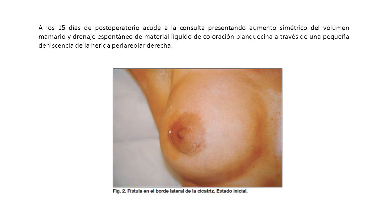A los 15 días de postoperatorio acude a la consulta presentando aumento simétrico del volumen mamario y drenaje espontáneo de material líquido de coloración blanquecina a través de una pequeña dehiscencia de la herida periareolar derecha.