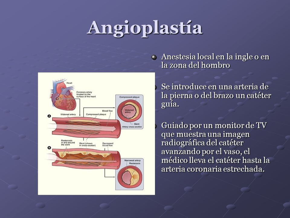 Angioplastía Anestesia local en la ingle o en la zona del hombro