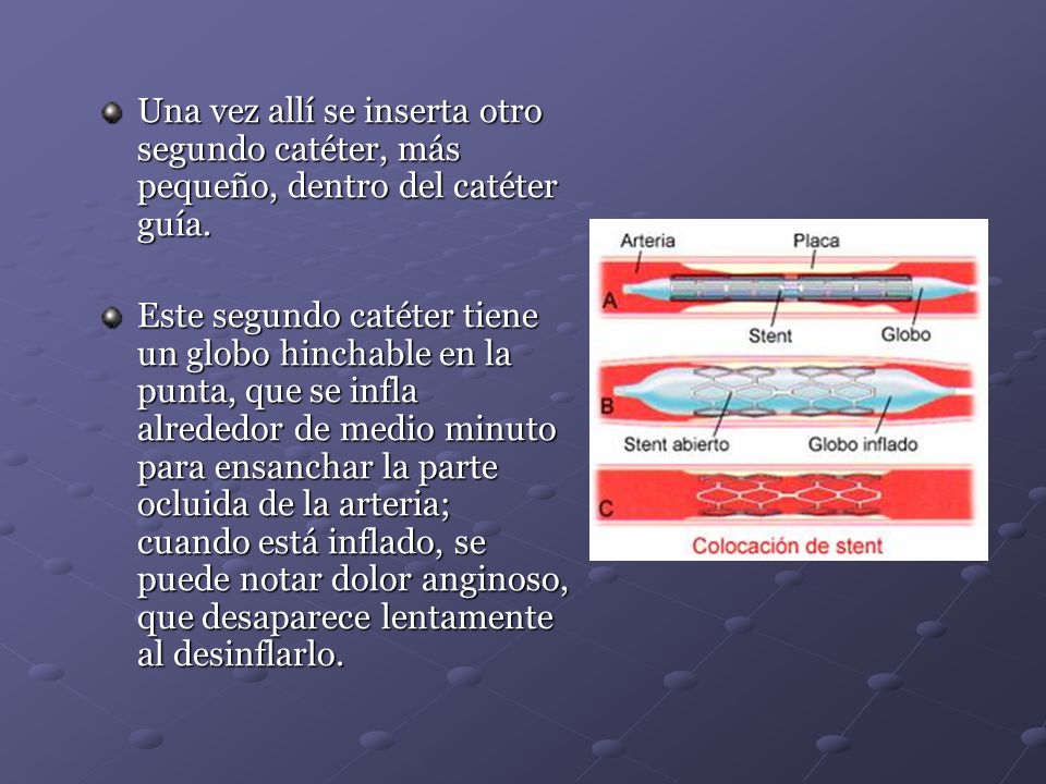 Una vez allí se inserta otro segundo catéter, más pequeño, dentro del catéter guía.