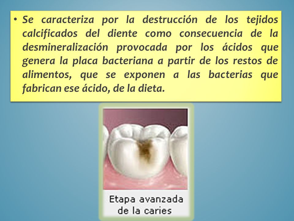 Se caracteriza por la destrucción de los tejidos calcificados del diente como consecuencia de la desmineralización provocada por los ácidos que genera la placa bacteriana a partir de los restos de alimentos, que se exponen a las bacterias que fabrican ese ácido, de la dieta.