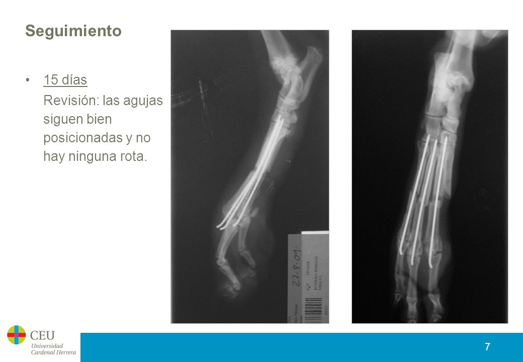 Seguimiento 15 días Revisión: las agujas siguen bien posicionadas y no hay ninguna rota.