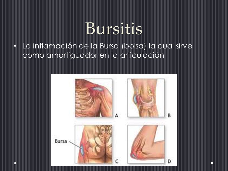 Bursitis La inflamación de la Bursa (bolsa) la cual sirve como amortiguador en la articulación