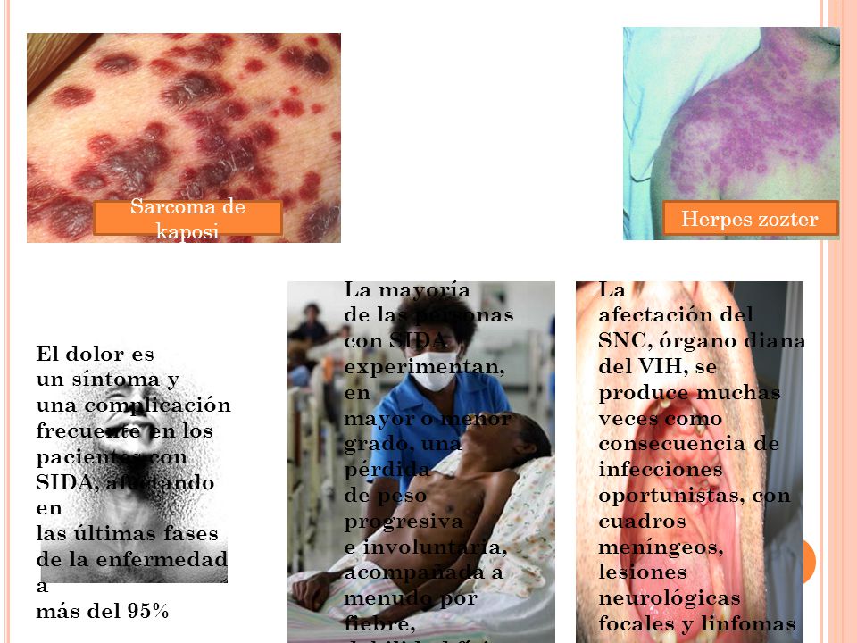 Sarcoma de kaposi Herpes zozter. La mayoría. de las personas. con SIDA. experimentan, en. mayor o menor.