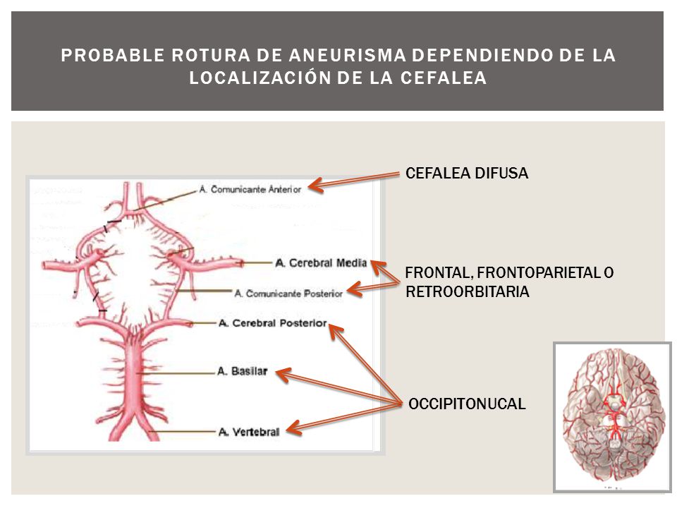 Probable rotura de aneurisma dependiendo de la localización de la cefalea