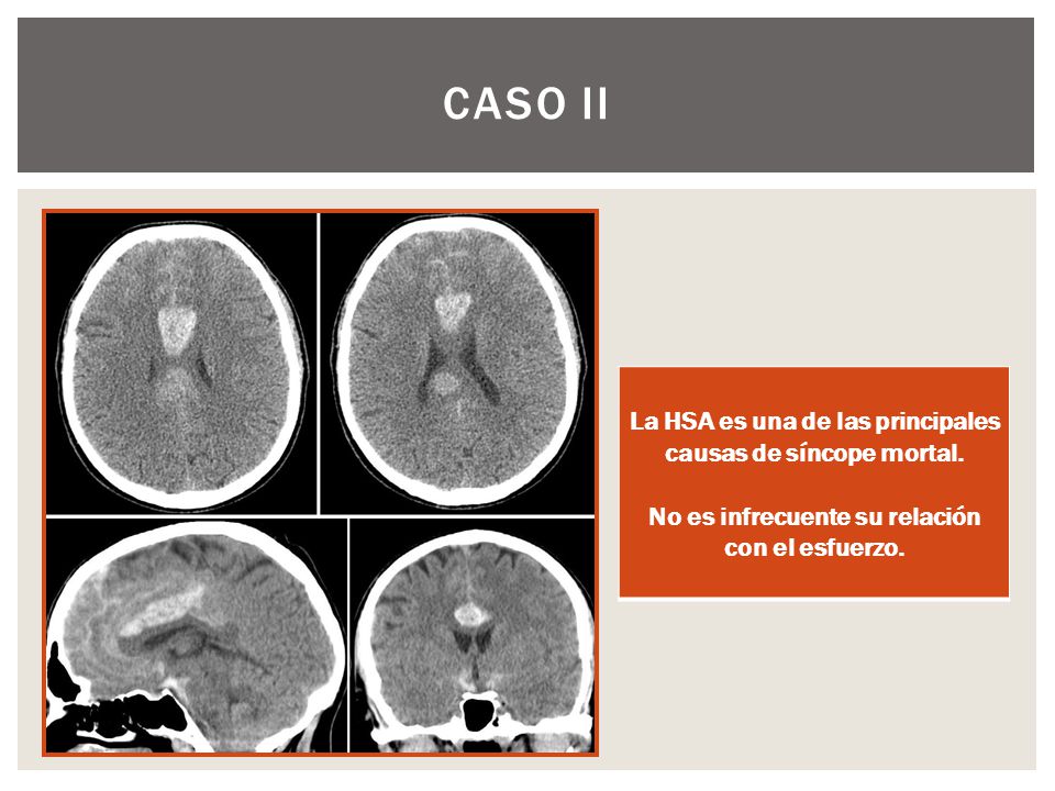 Caso ii La HSA es una de las principales causas de síncope mortal.