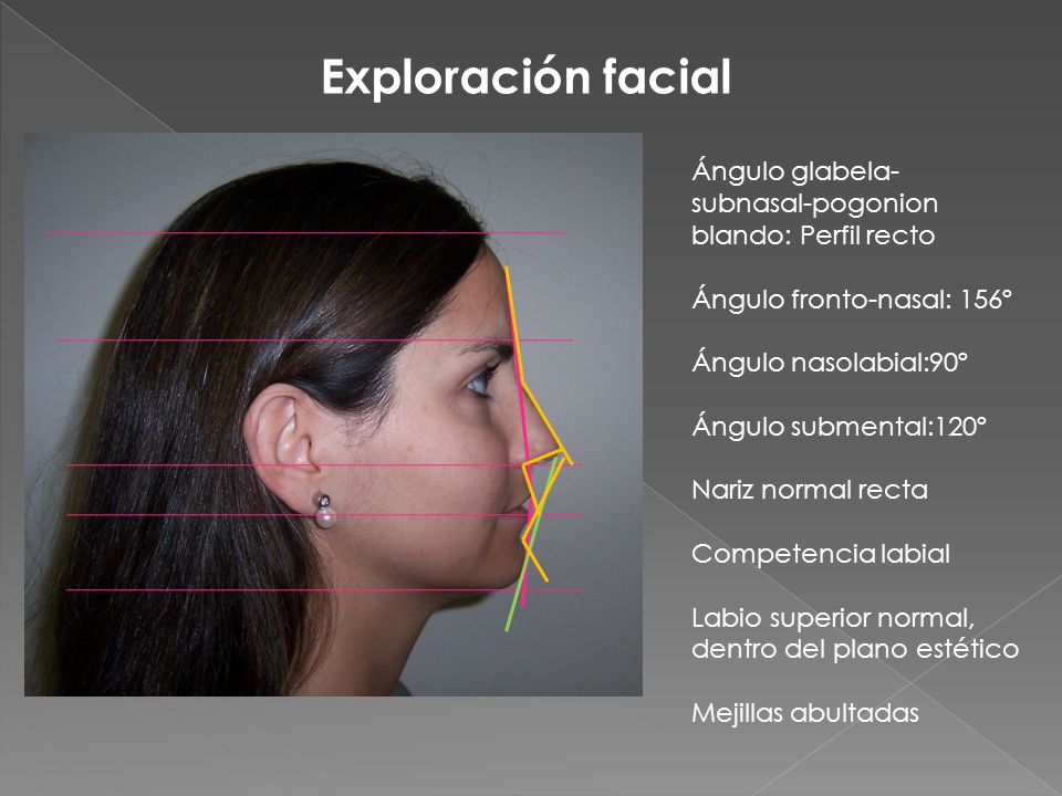 Exploración facial Ángulo glabela-subnasal-pogonion blando: Perfil recto. Ángulo fronto-nasal: 156º.