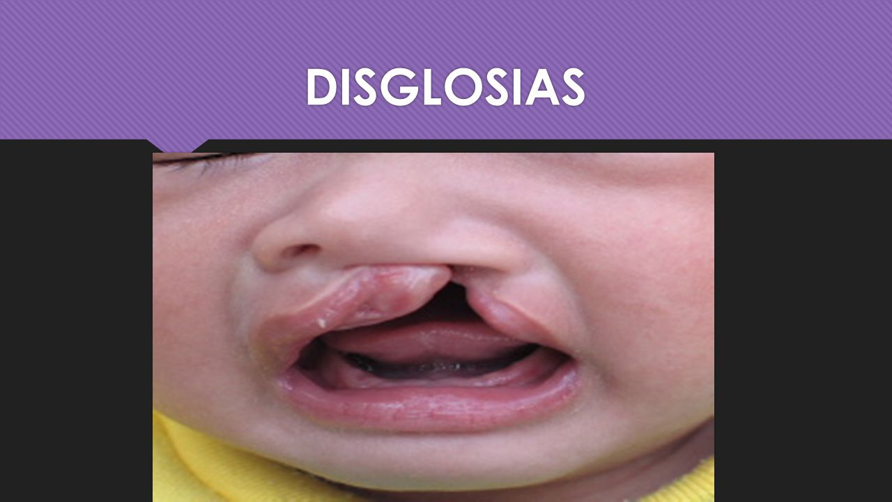 DISGLOSIAS