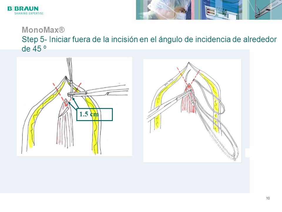 MonoMax® Step 5- Iniciar fuera de la incisión en el ángulo de incidencia de alrededor de 45 º