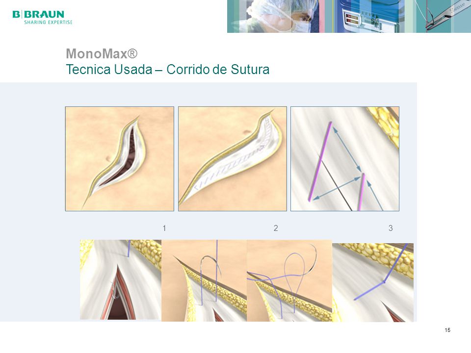 MonoMax® Tecnica Usada – Corrido de Sutura