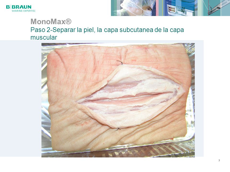 MonoMax® Paso 2-Separar la piel, la capa subcutanea de la capa muscular