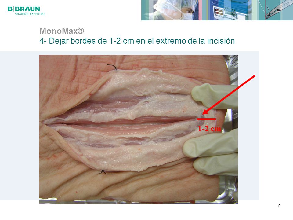 MonoMax® 4- Dejar bordes de 1-2 cm en el extremo de la incisión